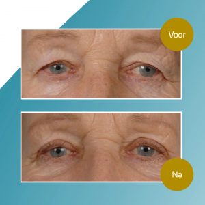 Voor en na foto van een ooglidcorrectie door de plastisch chirurg van MedCentric in Goes, Zeeland